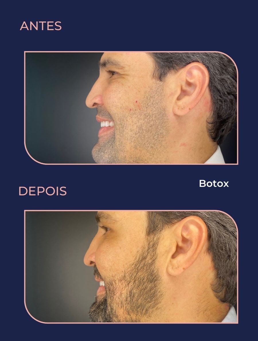 Antes-Depois 1