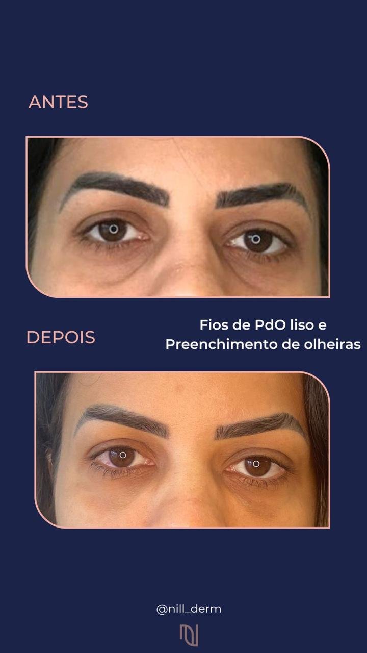 Antes-Depois 10
