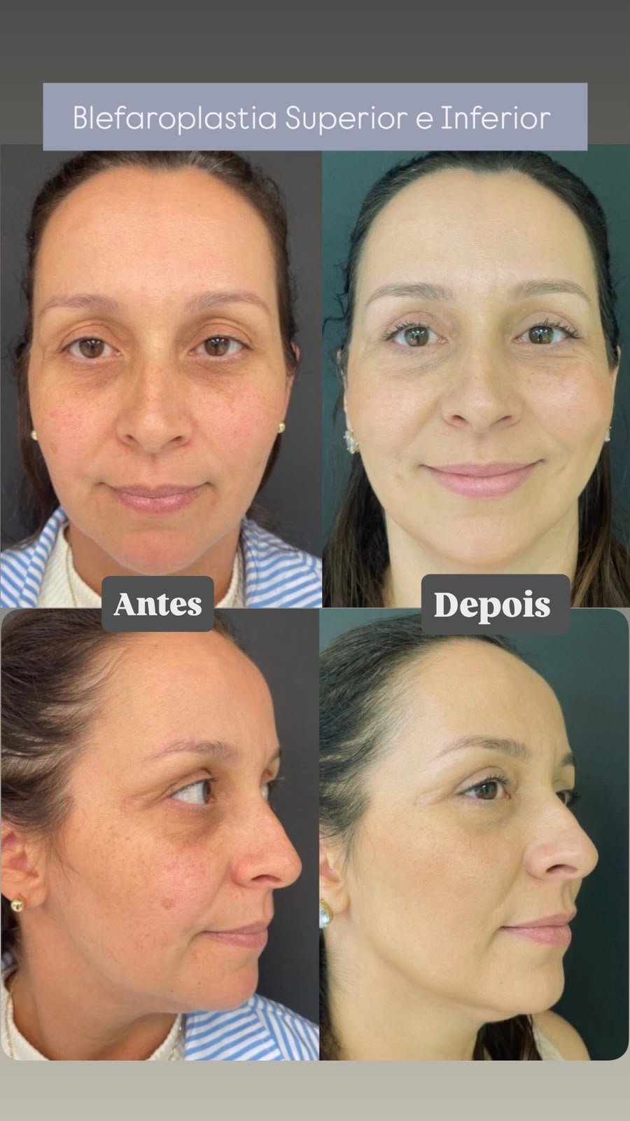 Antes-Depois 6